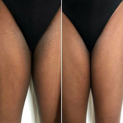 Inner Thigh Treatment