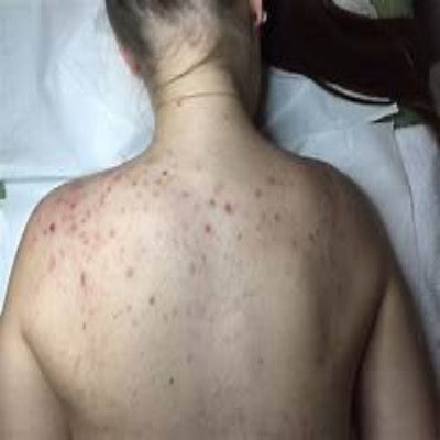 Bacial- exfoliating for your back