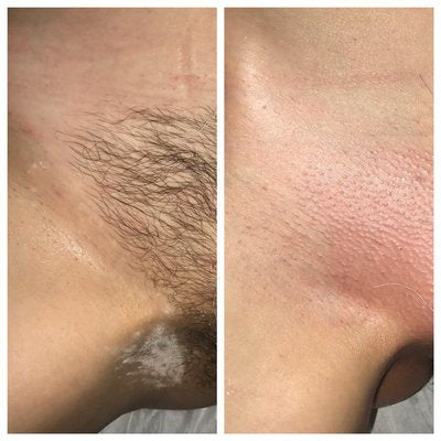 Brazilian Wax