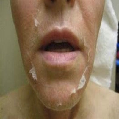 Advance Exfoliation (chemical peel) - TCA Peels