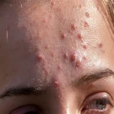Acne Attack Facial